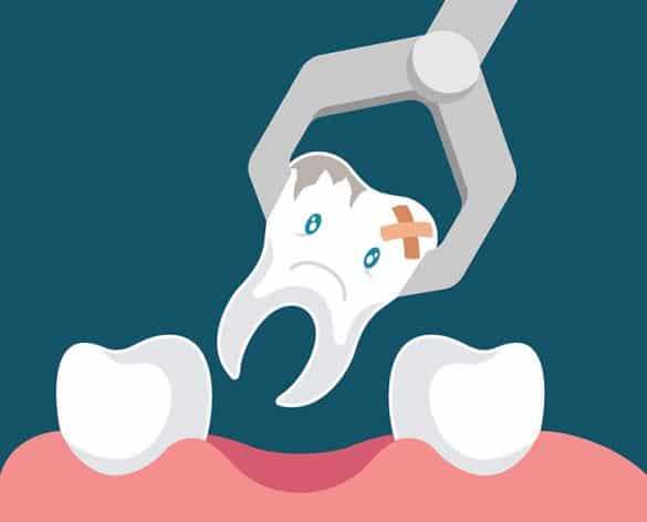 Tooth Extraction Care Brisbane Dentist