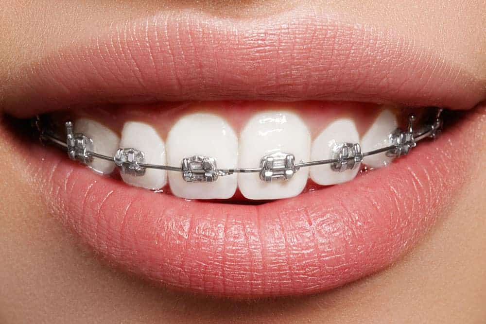 Braces Brisbane Cost